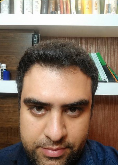 کاشت مو — بعد